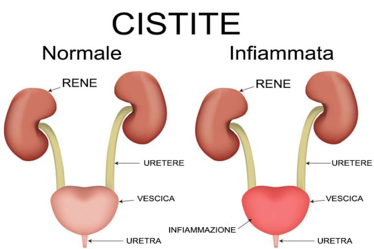 La Cistite: sintomi, cause, cura e rimedi naturali - Salute Online